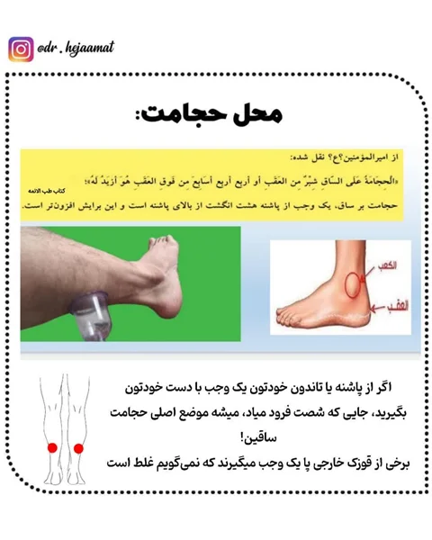 حجامت ساقین فواید و موارد برای کنترل بیماری ها: