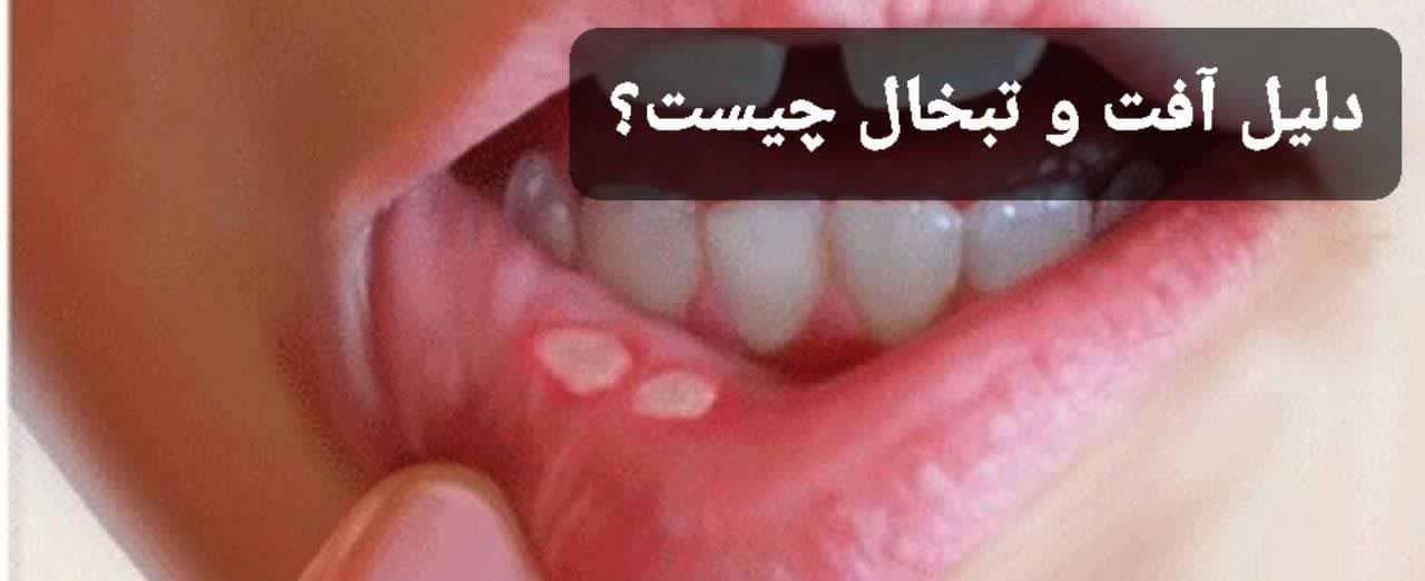 دلیل آفت و تبخال چیست ؟